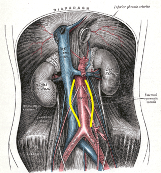 Aneurisma Aorta